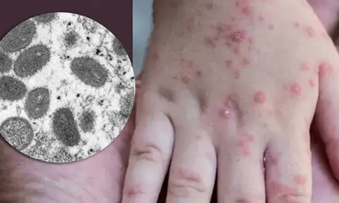 Van 3 mil 828 casos de viruela símica en México, así como 14 muertes