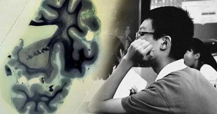 Joven de 19 años es diagnosticado con Alzheimer en China￼