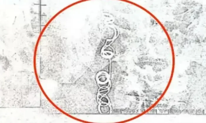 Se quejaba de dolor estomacal; tuvo una aguja en su intestino por 11 años