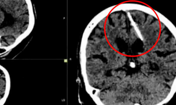 Abuelita se entera que tuvo una aguja en el cerebro por 80 años