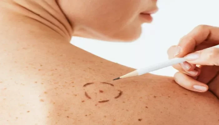 Nueva vacuna de Moderna reduce 49% el riesgo de muerte por cáncer en la piel