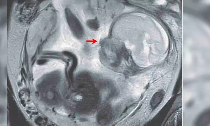 Mujer con calambres estomacales descubre que un bebé se desarrollaba en su intestino