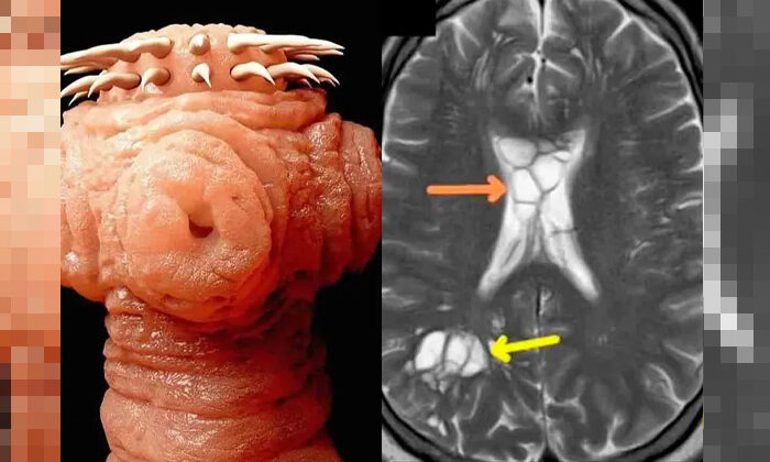Hombre descubre que sus migrañas eran ocasionadas por un gusano en su cerebro
