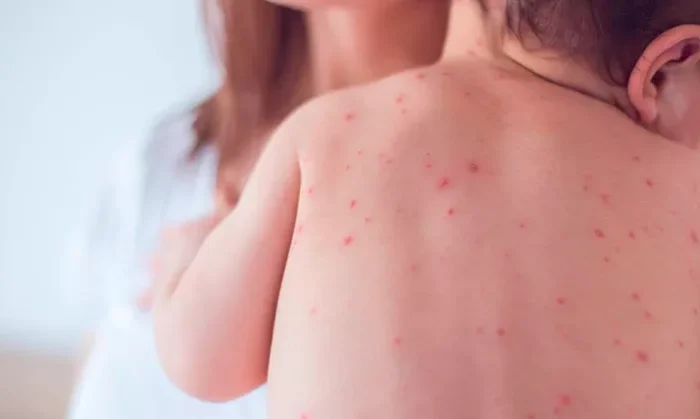 Salud emite alerta por casos importados de sarampión en México