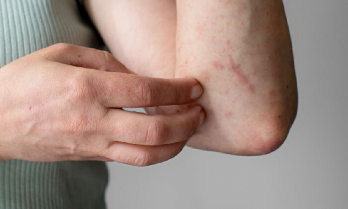 Te decimos qué es el síndrome de Stevens-Johnson y cómo identificar los síntomas