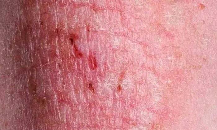 Alertan por nueva enfermedad de transmisión sexual altamente contagiosa