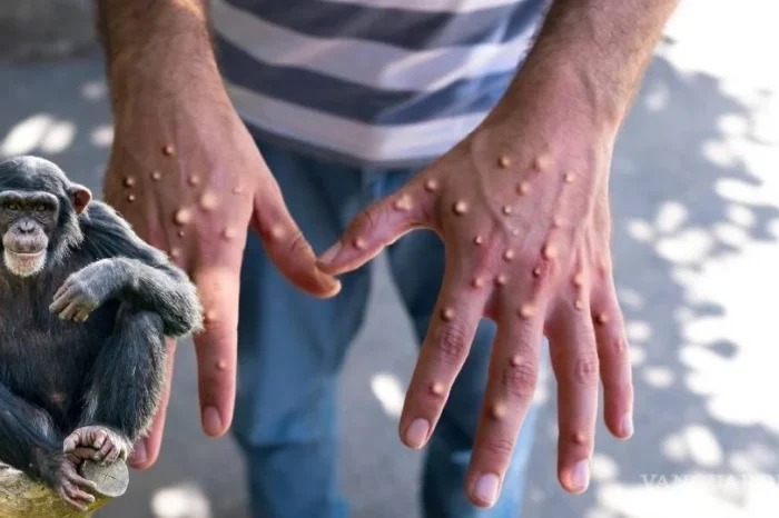 Nueva cepa de 'viruela del mono' se propaga en 26 países; OMS emite alerta