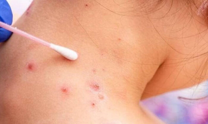 Refuerzan vigilancia contra viruela símica