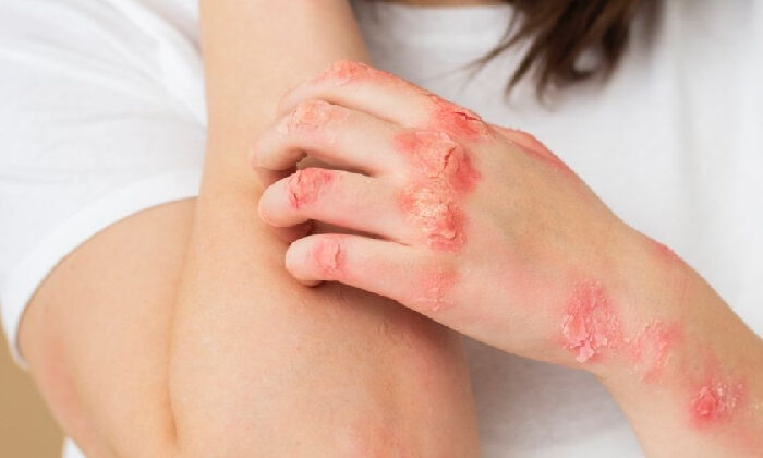 Estos estados han reportado casos de viruela del mono