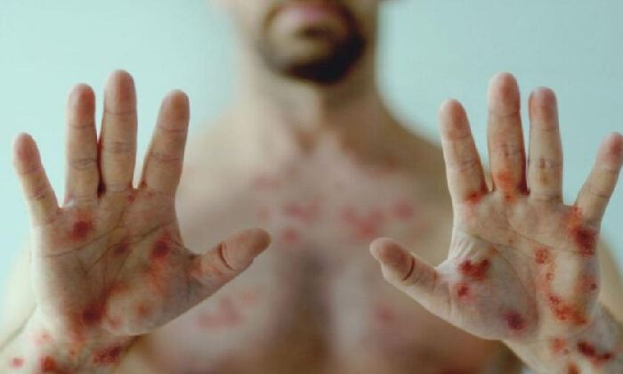 Registran caso de la nueva variante de viruela del mono en Argentina