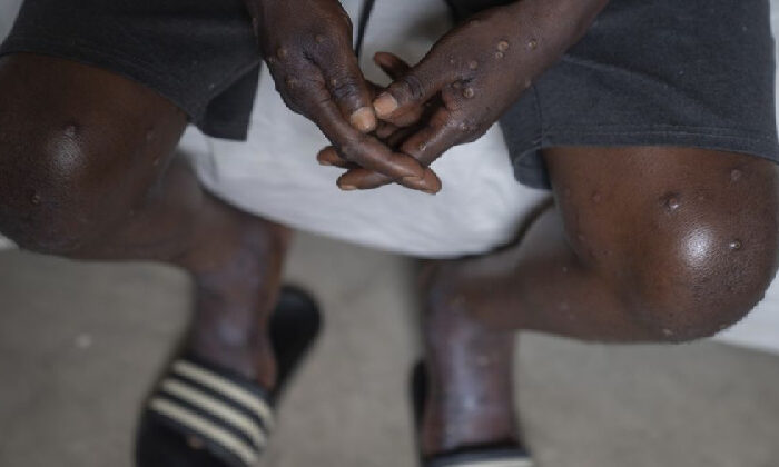 Detectan primer caso fuera de África de la nueva variante de viruela del mono