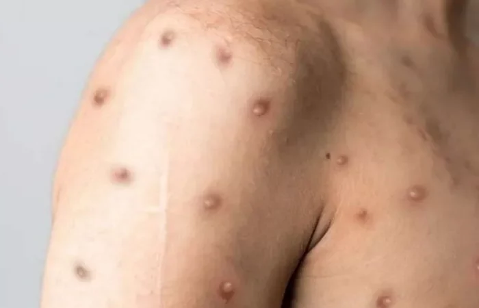 Viruela del mono: ¿Cuánto tiempo duran los síntomas y cómo cuidarse?