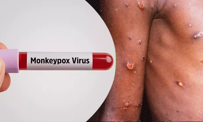 OMS declara emergencia mundial por viruela del mono