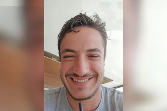 Joven terminó desfigurado tras un trasplante de barba realizado por falso cirujano