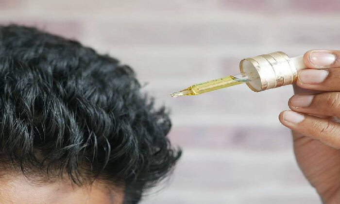 Medicamento contra la calvicie provoca bebés con «síndrome del hombre lobo»