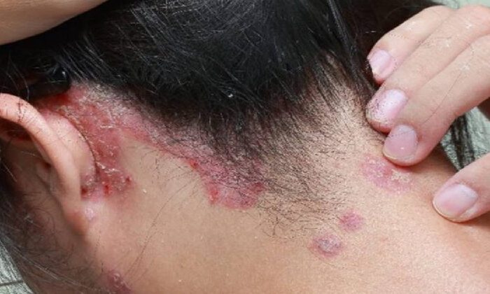 Detectan 5 casos de lepra en Tamaulipas