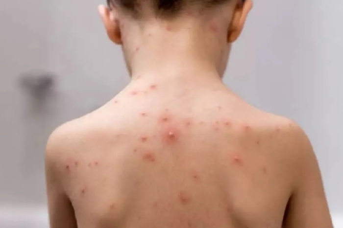 Aumentan a 255 casos de varicela en este 2026