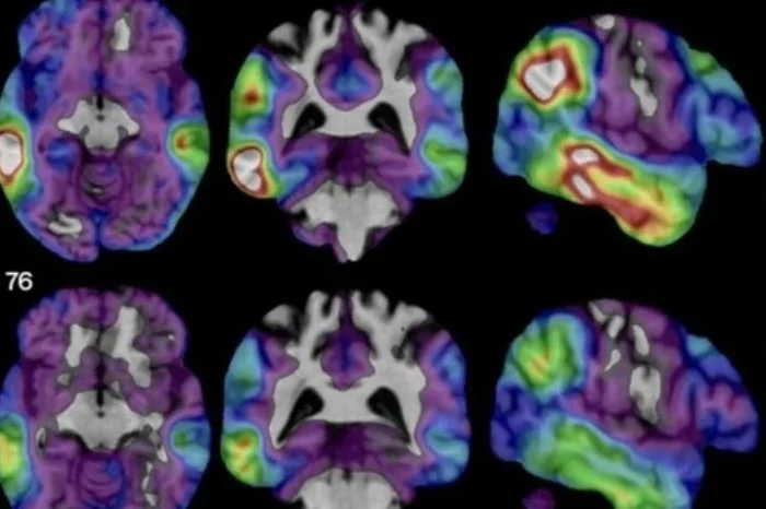 Análisis de sangre podría detectar Alzheimer hasta 10 años antes