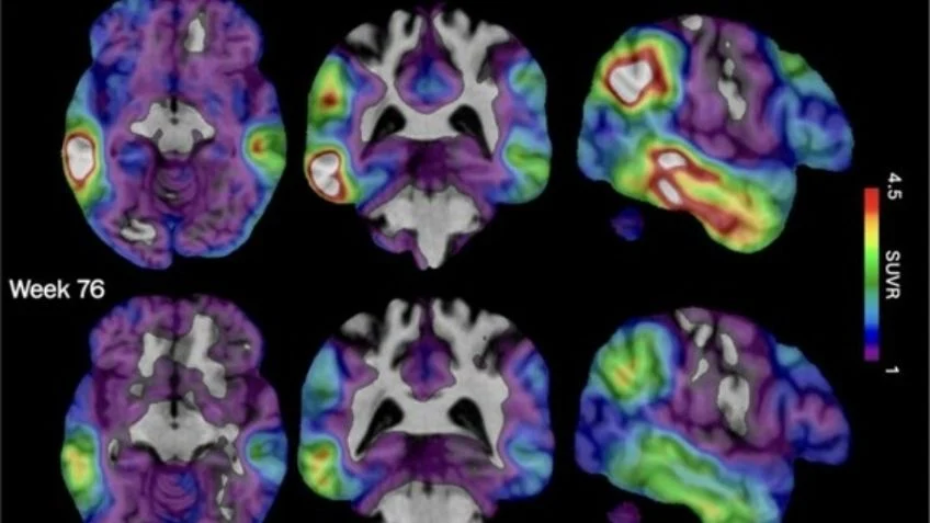 Análisis de sangre podría detectar Alzheimer hasta 10 años antes