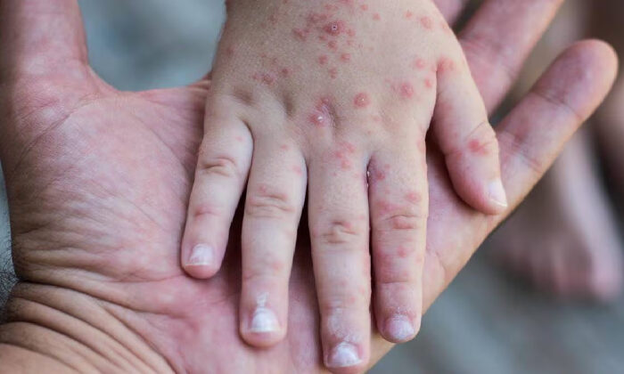 Casi 24 mil niños bajo la lupa de Salud por riesgo de sarampión