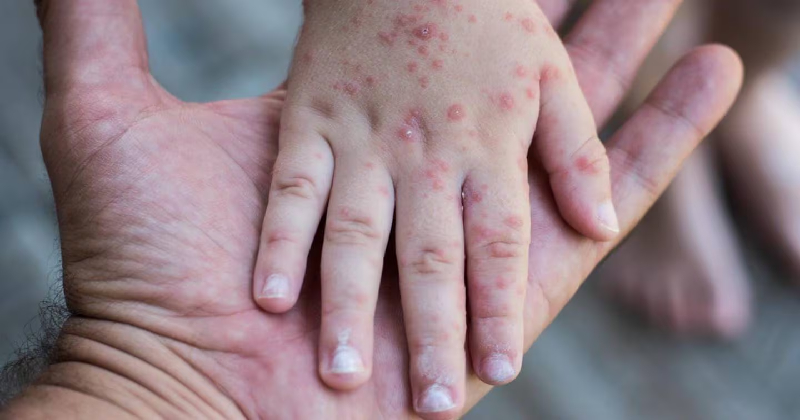 Casi 24 mil niños bajo la lupa de Salud por riesgo de sarampión